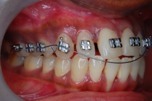 What Is Orthodontia? | Orthodontics