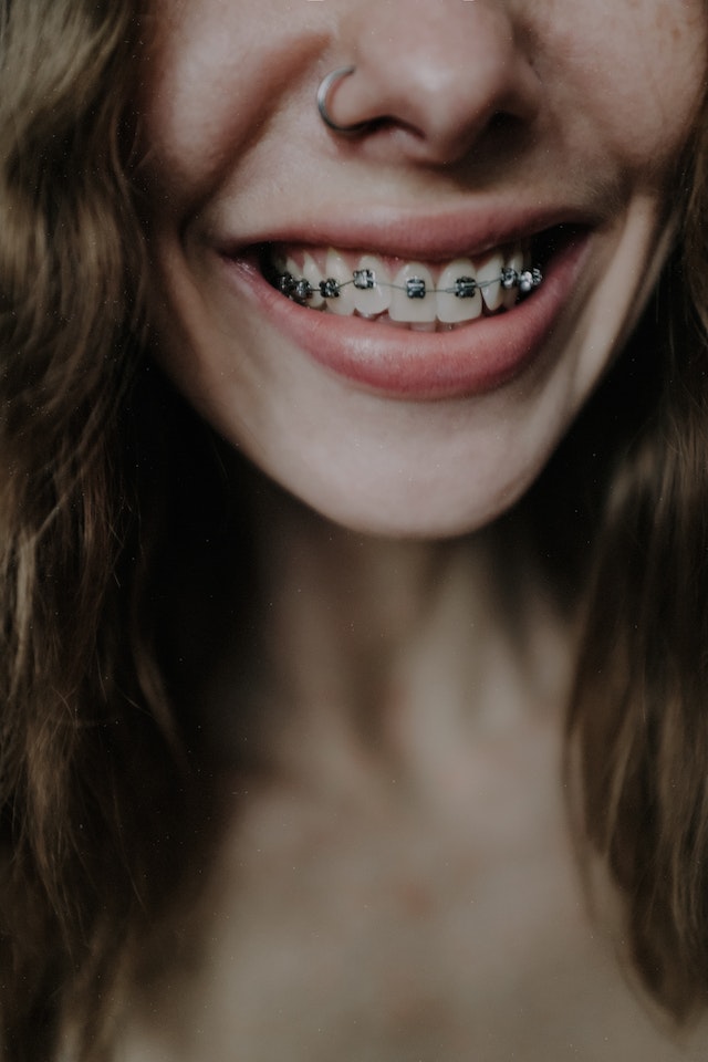 Best types of braces 2023-NYC Orthodontist